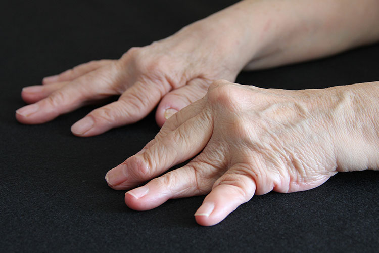 関節リウマチが腎臓に与える影響